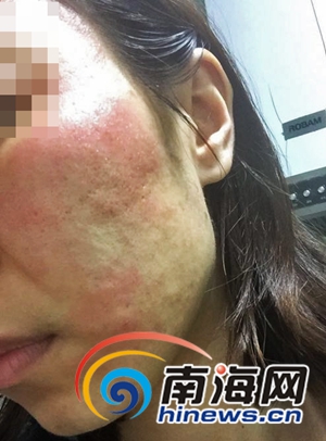 美容导致过敏如何要求赔偿,女子美容后脸部红肿要求万元赔偿