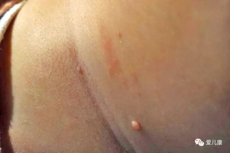 传染性软疣和痘痘的区别,宝宝长痘痘需要检查哪些