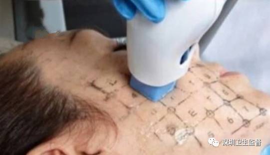 超声刀抗衰老美容仪,抗衰老医美超声刀