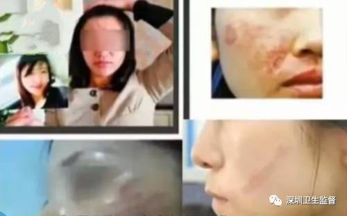 超声刀抗衰老美容仪,抗衰老医美超声刀