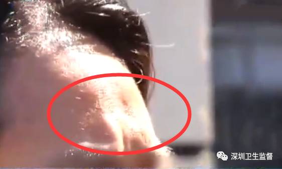 超声刀抗衰老美容仪,抗衰老医美超声刀