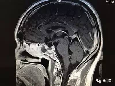「赞」打开上帝之窗—佛中医经鼻腔切除颅内肿瘤