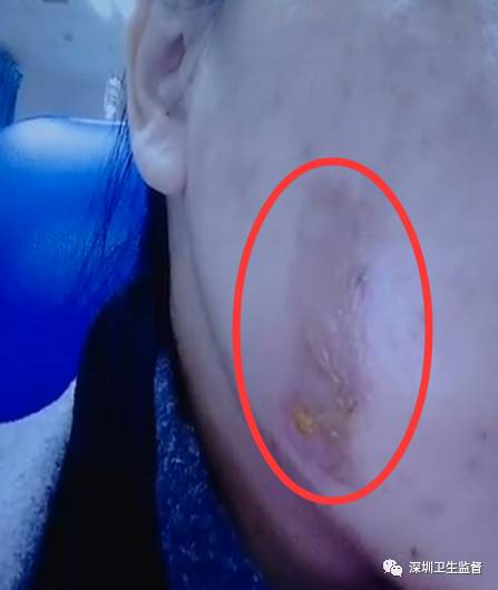 超声刀抗衰老美容仪,抗衰老医美超声刀