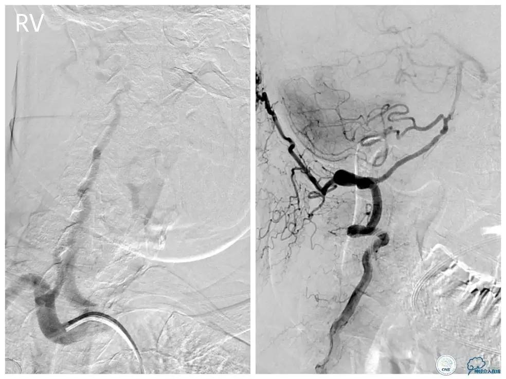 天坛椎动脉狭窄,天坛周记