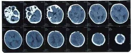 西苑医院偏头痛,脑病科头疼原因
