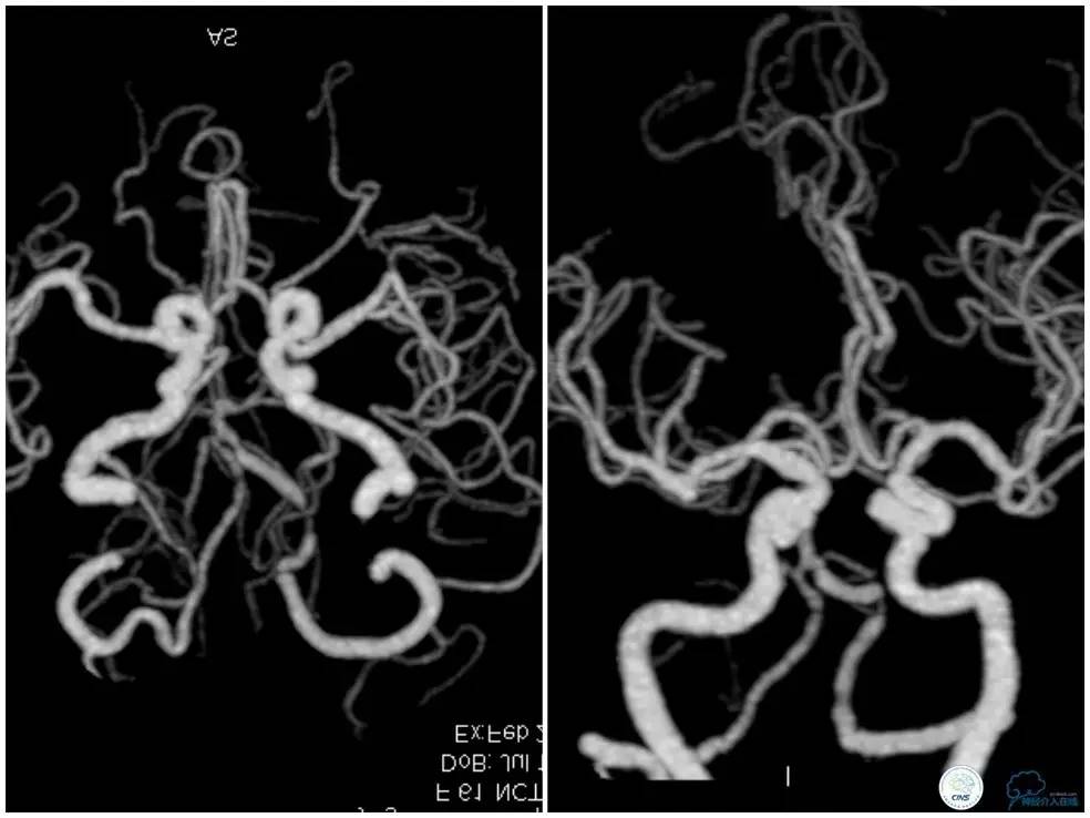 天坛椎动脉狭窄,天坛周记