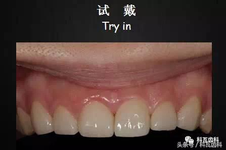 门牙旁边有缝最好的解决方法,门牙缝漏怎么补救