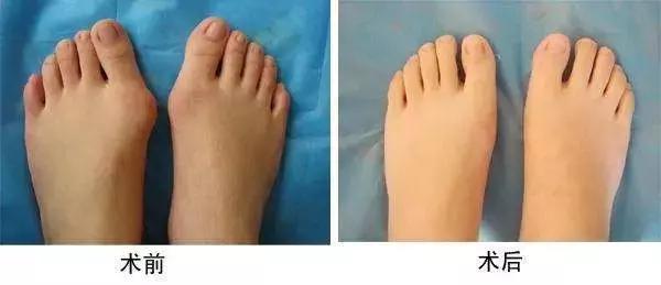 高跟鞋还是少穿吧,许多明星的高颜值,都毁在了一双脚上!