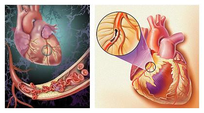 高血压引起心脏早搏怎么办,感冒引起的心脏早搏怎么办