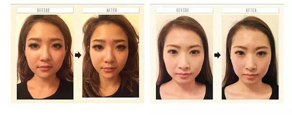 整骨瘦脸手术怎么做,日本整骨瘦脸手法图解