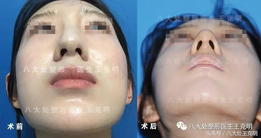 肋软骨隆鼻如何选择合适的形态,肋软骨隆鼻和耳软骨隆鼻哪个安全