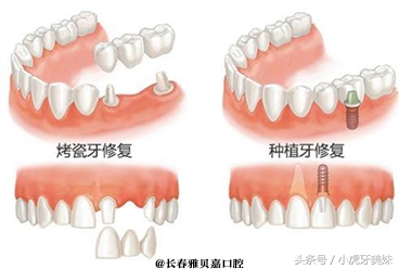 烤瓷牙与种植牙的区别（yarbeija科普）