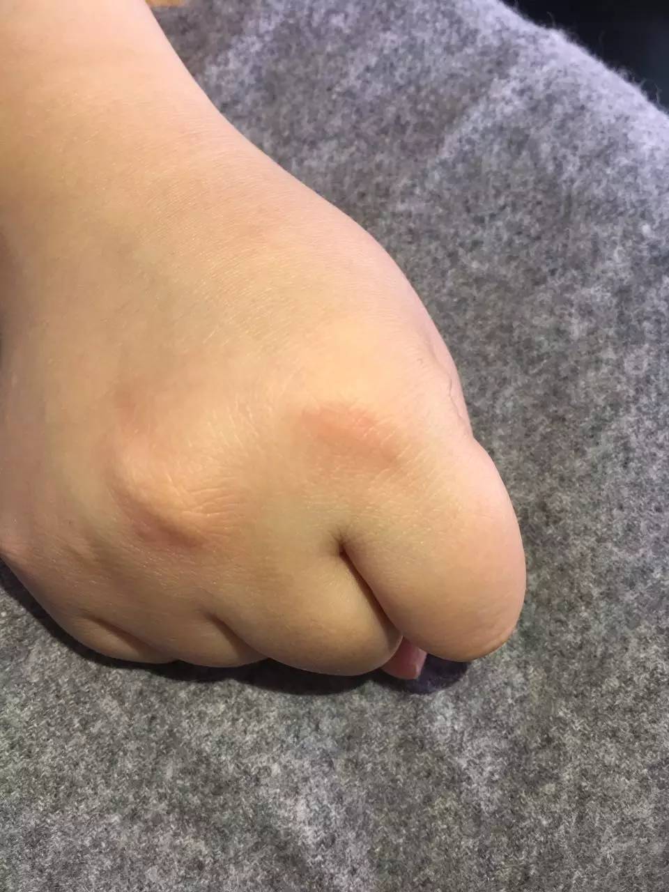 压疮最新指南解读是哪一年的,压疮科普知识