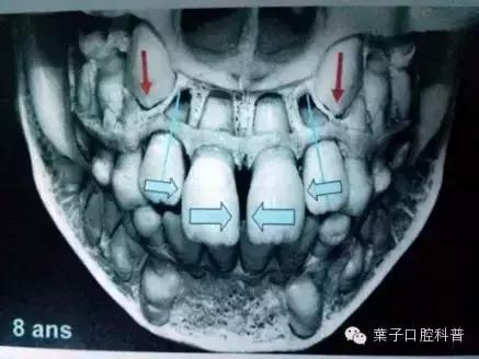 恒牙换牙不,恒牙不长出