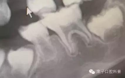 恒牙换牙不,恒牙不长出