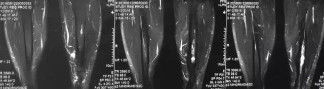 骨折内固定伤口处流脓是为什么,骨折固定支架外部流脓怎么处理