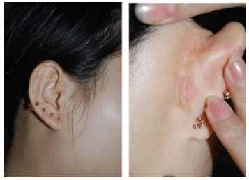 耳软骨垫鼻尖后期会塌吗,耳软骨垫鼻尖后期会下垂吗