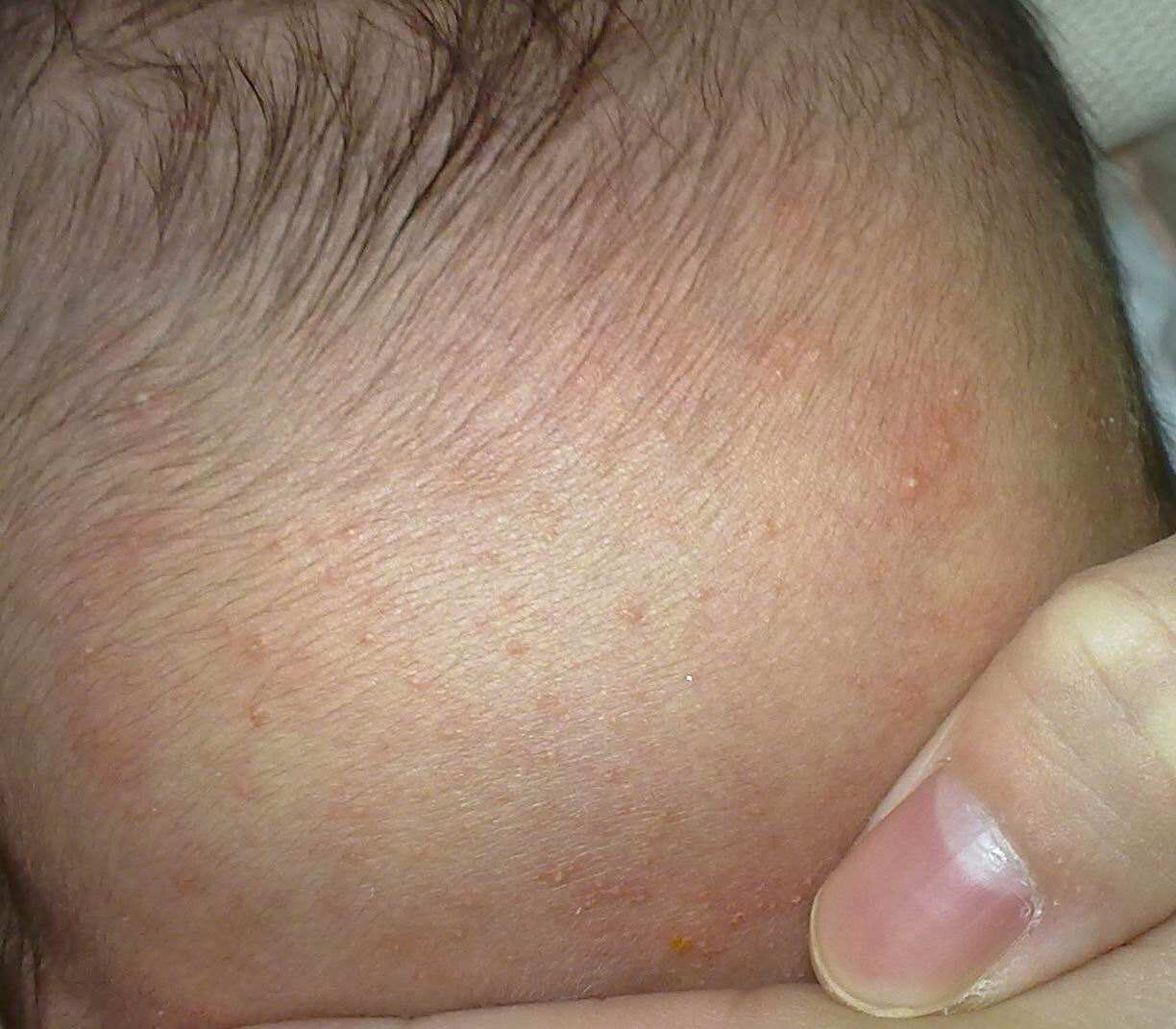 婴儿为什么会长湿疹,婴儿红疹和湿疹区别