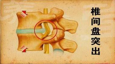 腰椎间盘突出教你一招瞬间止痛,mulligan手法治疗腰椎间盘突出