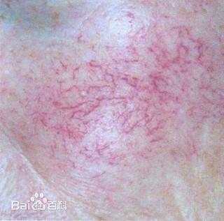 真正祛红血丝有效的方法,去除红血丝怎么操作