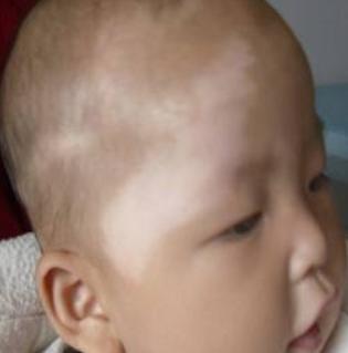 小孩子长了白斑怎么才能治好,声带白斑要注意哪些饮食