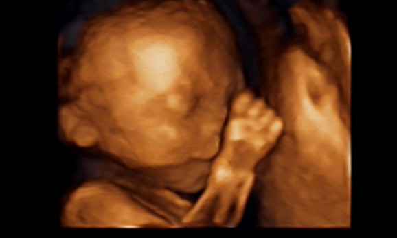 b超查出来宝宝兔唇怎么办,b超照出胎儿有兔唇