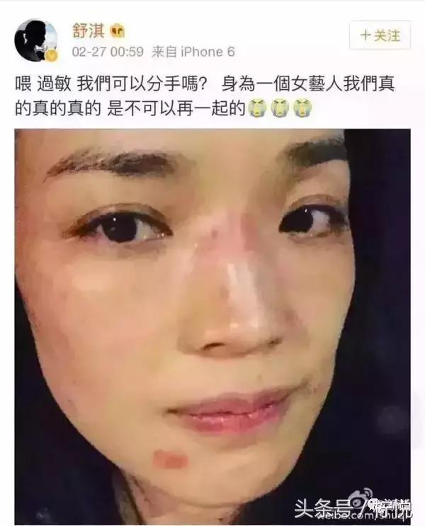 舒淇经常过敏,舒淇过敏好了吗
