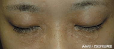 眼周很多小颗粒怎么办,眼周起斑点是什么原因