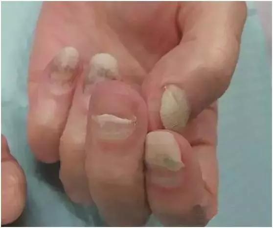 指甲变色变厚怎么处理,指甲变色了怎么办