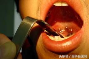 扁桃体发炎反复发烧39度多怎么办,10岁儿童扁桃体反复发炎吃什么药