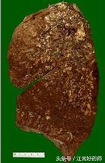 各种咳嗽的病症都有什么食疗,常见咳嗽有什么特效药