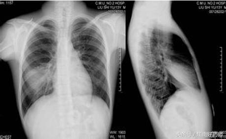 各种咳嗽的病症都有什么食疗,常见咳嗽有什么特效药