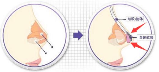 耳软骨垫鼻尖后期会塌吗,耳软骨垫鼻尖后期会下垂吗