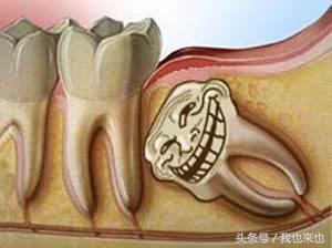 拔掉阻生齿的好处,拔掉阻生齿后牙洞怎么办
