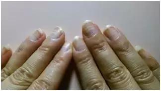 指甲变色变厚怎么处理,指甲变色了怎么办