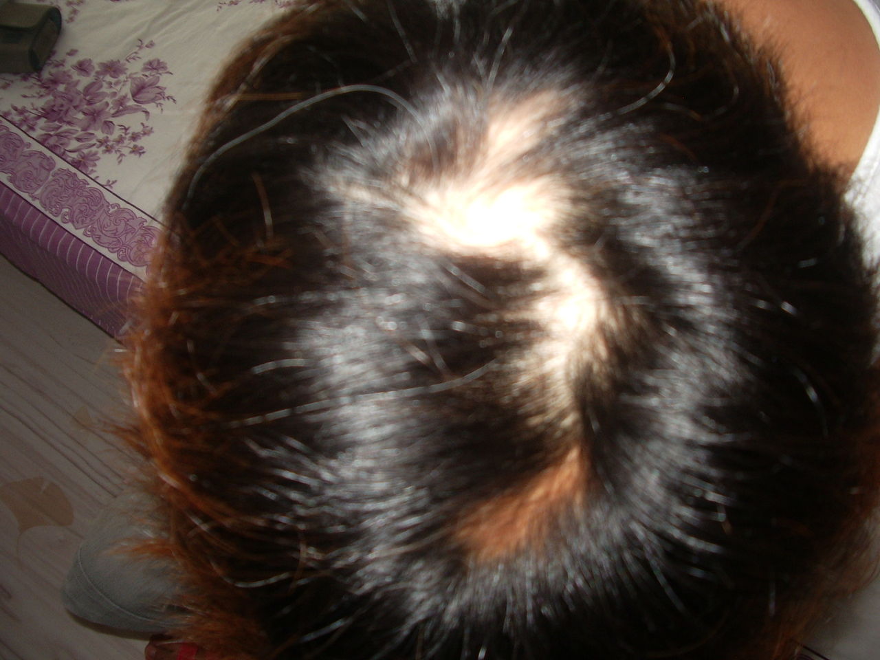 为什么现在的人脱发掉发严重,为什么年轻人老是掉头发