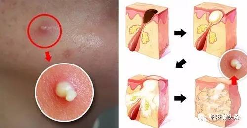 挤痘痘留下的痘印大概多久会好,挤痘留下的红色痘印怎么祛除