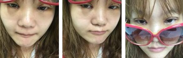 割双眼皮的危害和后遗症,拆双眼皮线痛吗