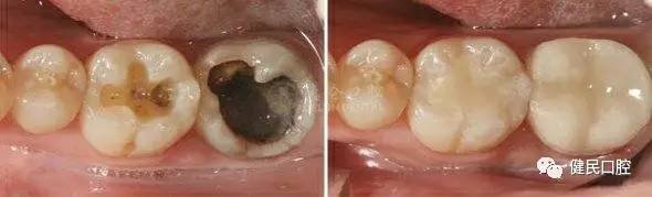 蛀牙根管治疗视频,蛀牙应该怎么治疗最好