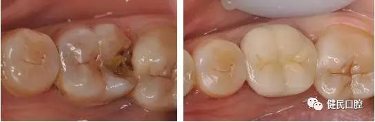 蛀牙根管治疗视频,蛀牙应该怎么治疗最好