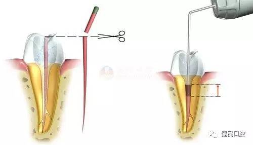 蛀牙根管治疗视频,蛀牙应该怎么治疗最好