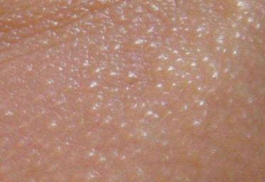 眼睛下面长了脂肪粒怎么解决,眼睛下面长满脂肪粒是什么原因