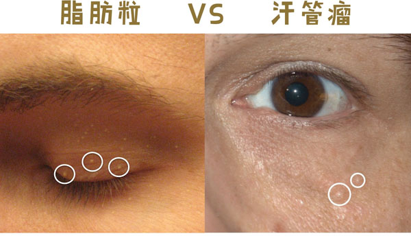 眼睛下面长了脂肪粒怎么解决,眼睛下面长满脂肪粒是什么原因