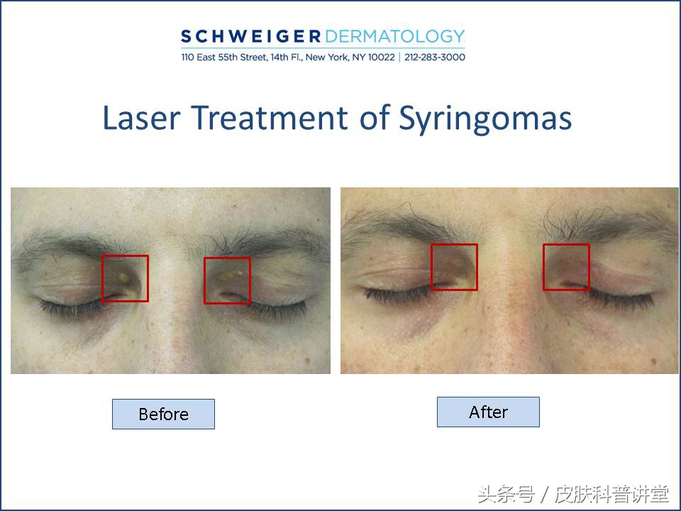 眼周很多小颗粒怎么办,眼周起斑点是什么原因