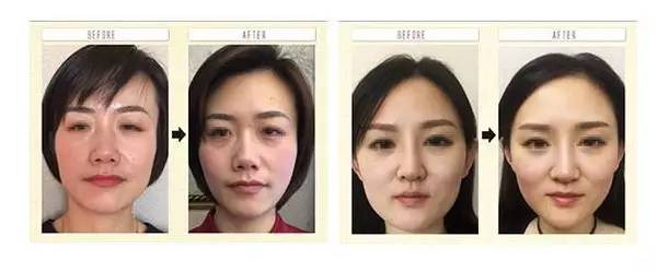 整骨瘦脸手术怎么做,日本整骨瘦脸手法图解