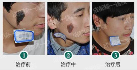 胎记算命揭秘,胎记算命真的可信吗女生