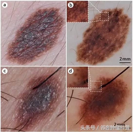 恶性黑色素瘤的表现诊断与治疗,黑色素瘤愈后的伴随检查