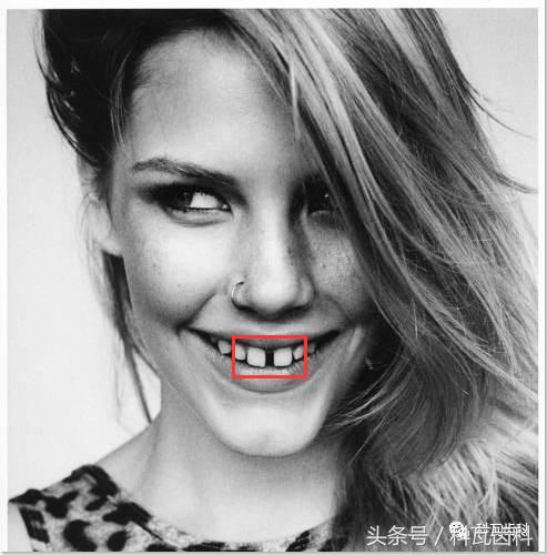 门牙旁边有缝最好的解决方法,门牙缝漏怎么补救