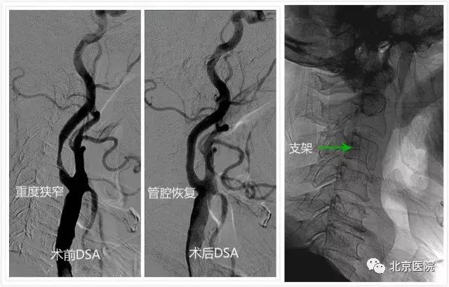 颈动脉狭窄支架手术是微创手术吗,颈动脉狭窄支架手术效果