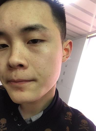 熬夜通宵加班脸上长痘,熬夜加班受不了了